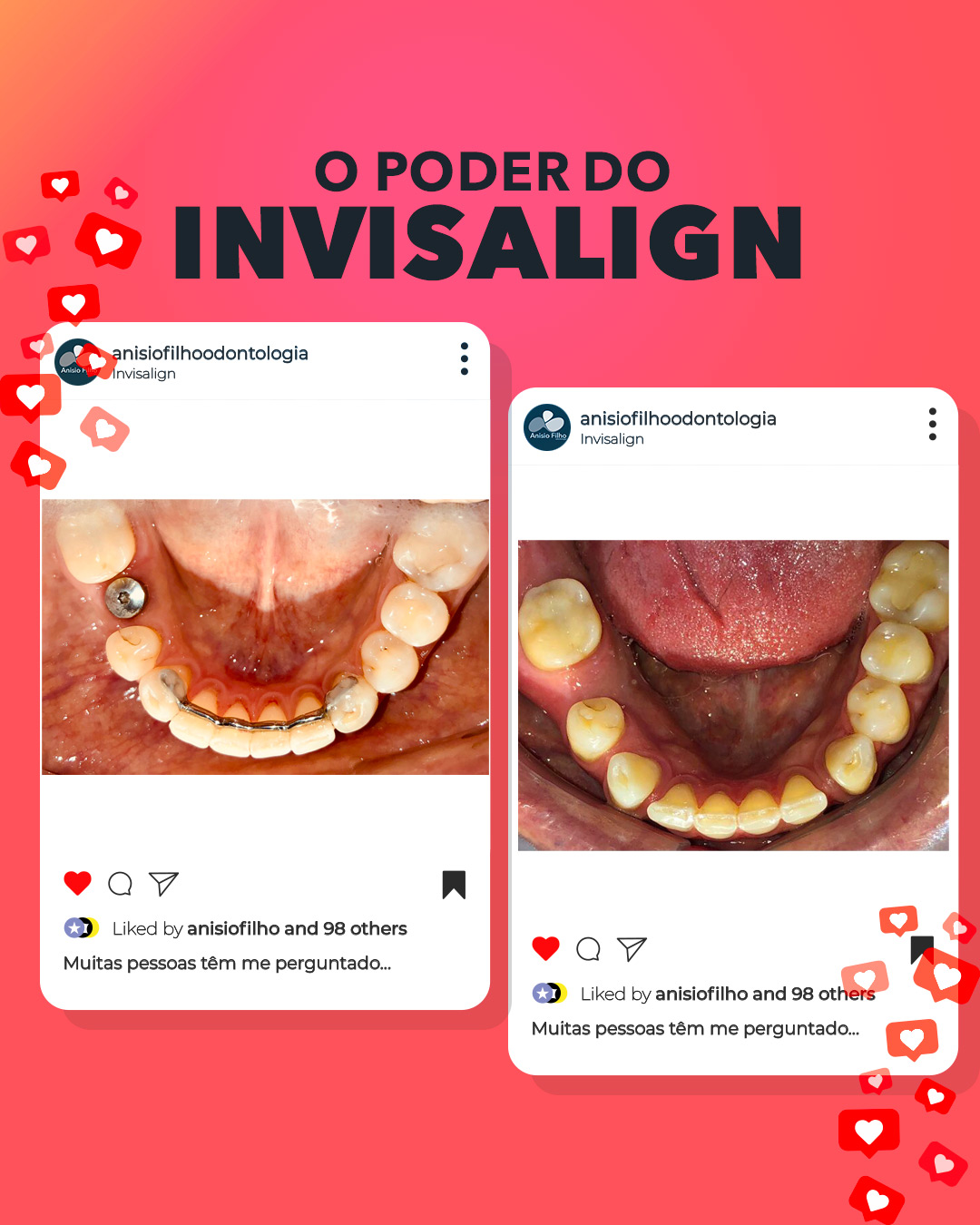 Read more about the article O poder dos tratamentos com Invisalign.